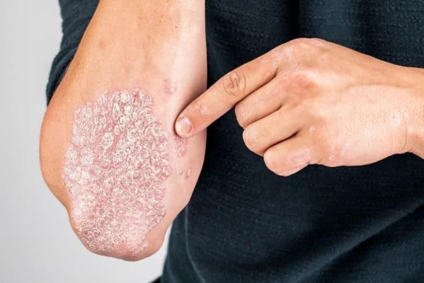 Bệnh vảy nến có tự hết không? Các biện pháp khắc phục hiệu quả