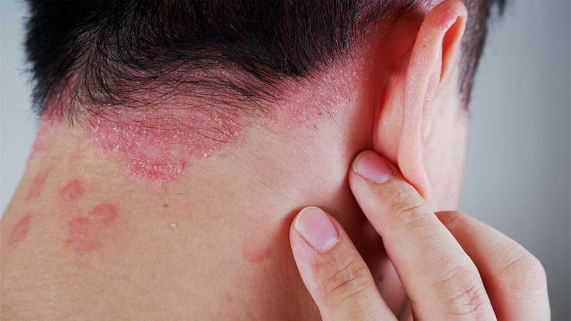 Bệnh vảy nến là gì?