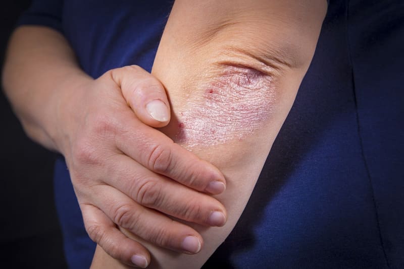 Nguyên nhân gây ra bệnh vảy nến