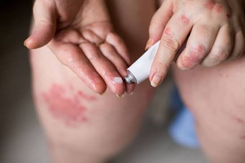 Điều trị vảy nến với thuốc