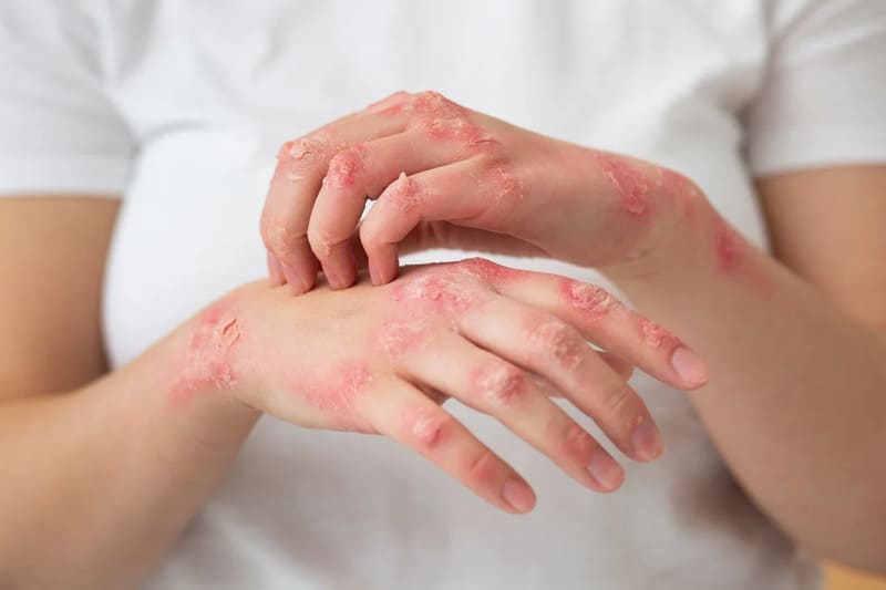 Vảy nến là bệnh gì?