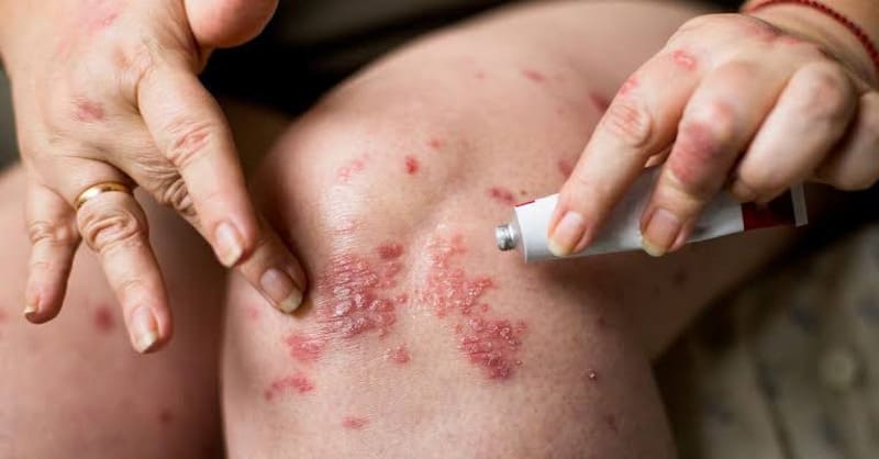 Điều trị bệnh vảy nến bằng thuốc bôi ngoài da