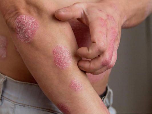 Vảy nến có di truyền không? Có lây từ mẹ sang con không?
