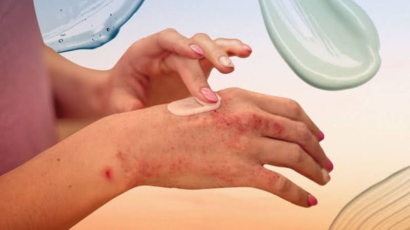 Sử dụng thuốc bôi điều trị tình trạng vảy nến nhẹ