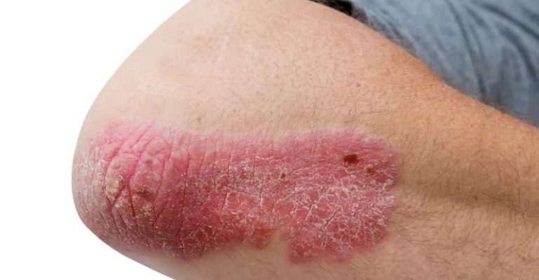 Vảy nến có lây không