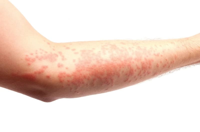 Bệnh vảy nến có lây không?