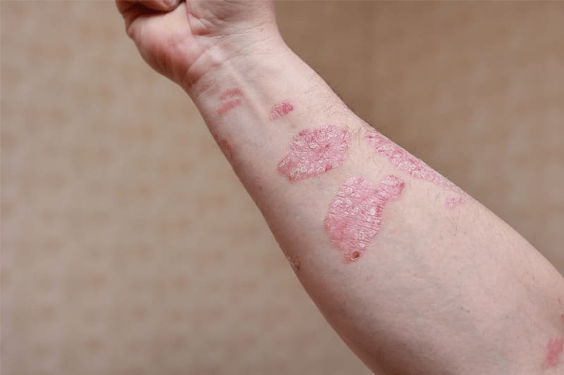 Làm sao để nhận biết bị vảy nến?