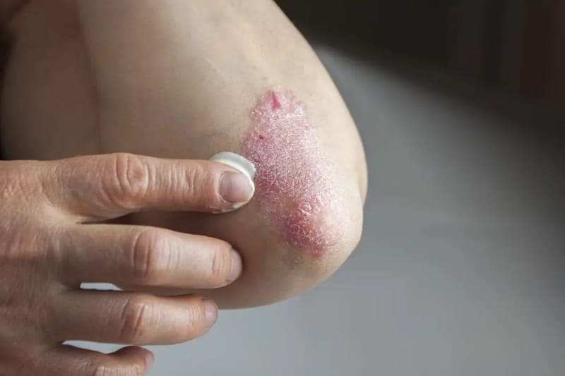 Chữa bệnh vảy nến bằng thuốc bôi ngoài da