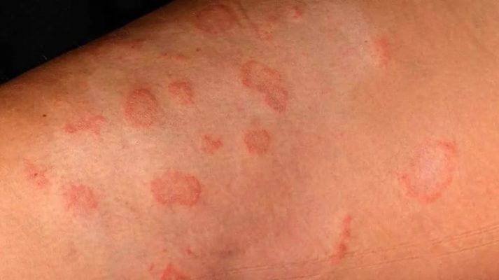 Vảy nến đồng tiền: Nguyên nhân, triệu chứng và cách điều trị đúng