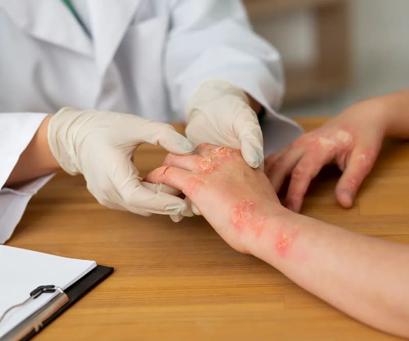 Nguyên nhân của vảy nến thể đồng tiền