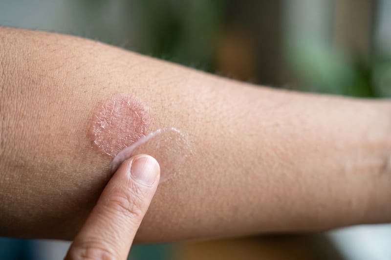 Cách điều trị vảy nến đồng tiền đúng