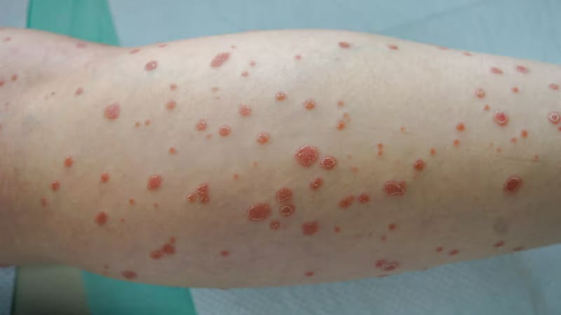 Vảy nến thể giọt là gì?