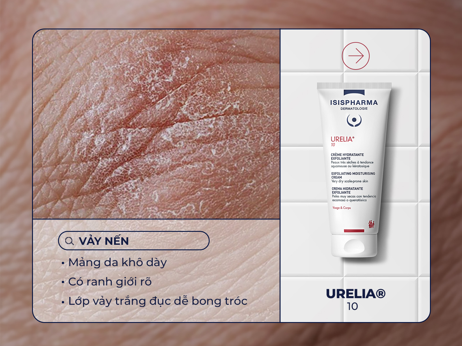 Kem dưỡng chuyên biệt cho da vảy nến URELIA 10