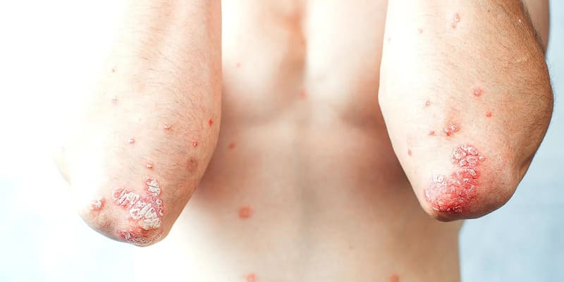 Vảy nến thể mảng là gì?