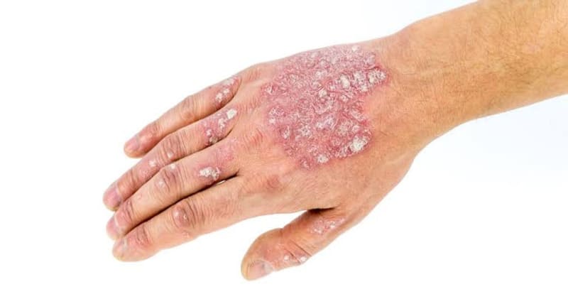 Dấu hiệu nhận biết vảy nến thể mảng