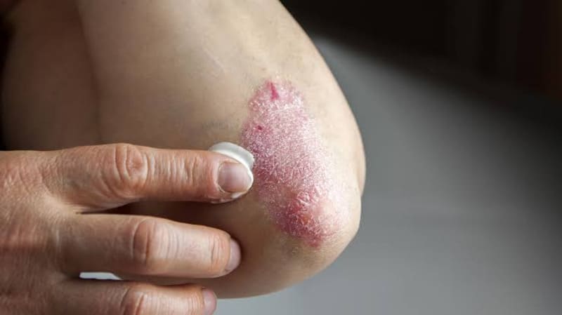 điều trị vảy nến thể mảng bằng thuốc bôi