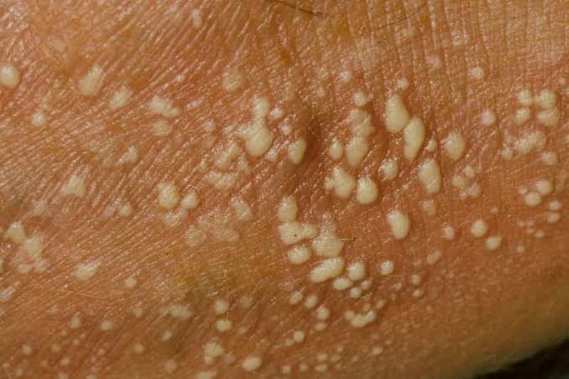 Nguyên nhân gây ra vảy nến thể mủ