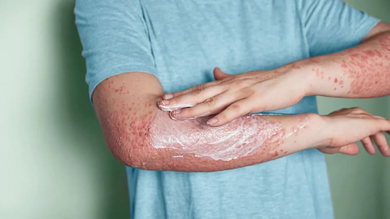điều trị bệnh vảy nến thể mủ giai đoạn ổn định