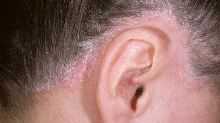 bệnh vảy nến da đầu