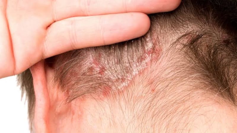 Rối loạn hệ thống miễn dịch là nguyên nhân gây vảy nến da đầu