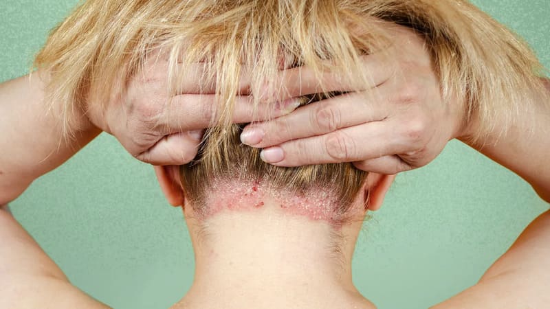 Triệu chứng bệnh vảy nến da dầu