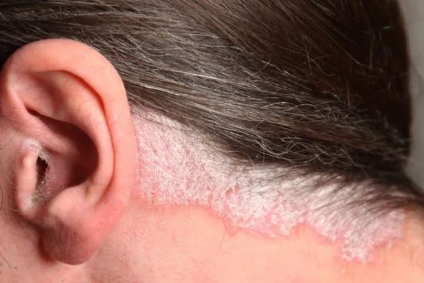 Vảy nến da đầu có lây không? Cách trị như thế nào?