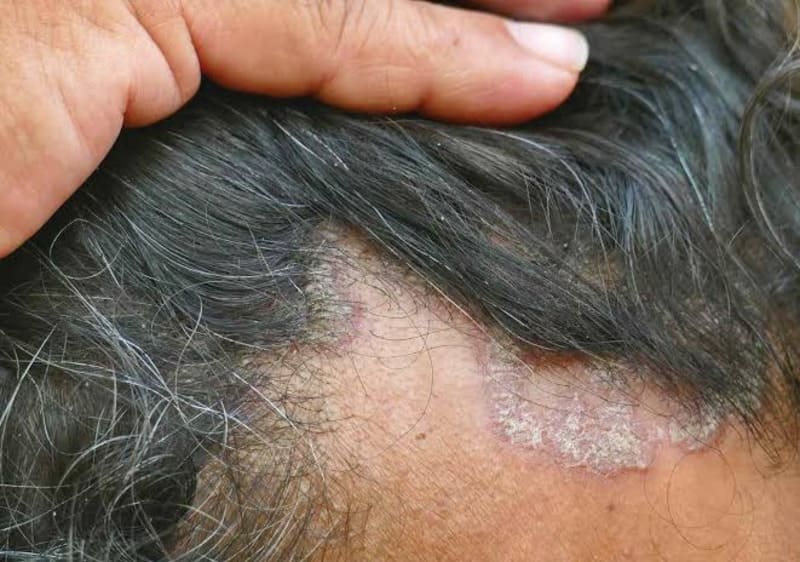 Vảy nến da đầu là gì?