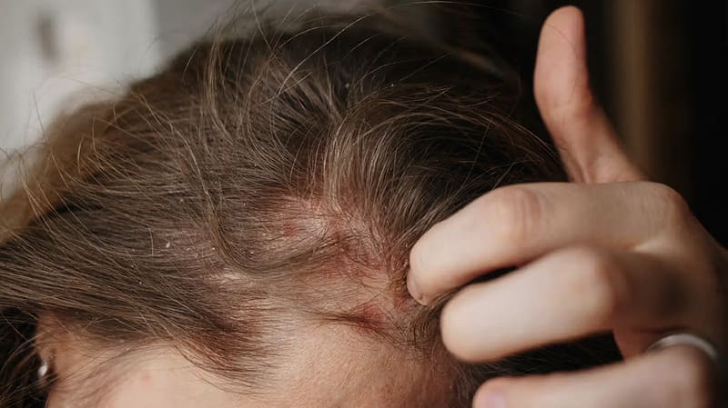 Vảy nến da đầu có lây không?