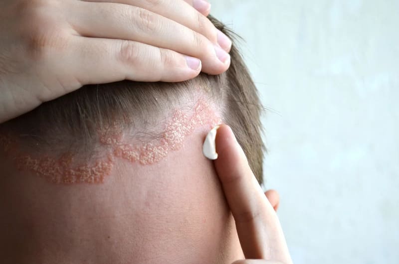 Sử dụng thuốc bôi tại nhà điều trị vảy nến da đầu