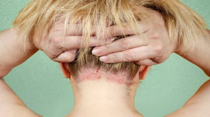 vảy nến da đầu và nấm da đầu