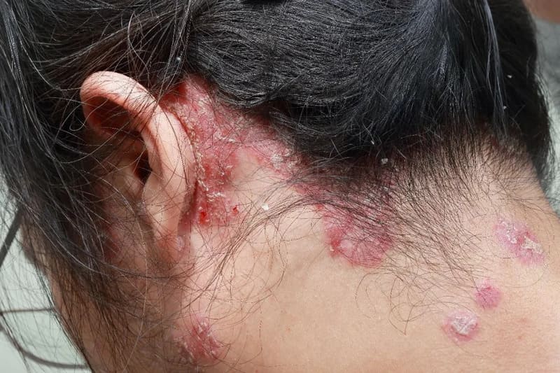 Vảy nến da đầu là gì?