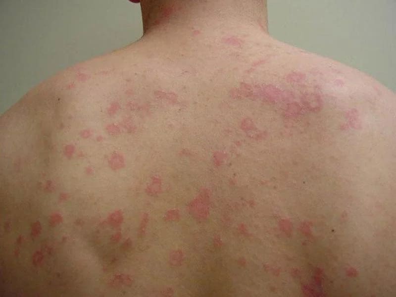 Vảy nến phấn hồng là gì?