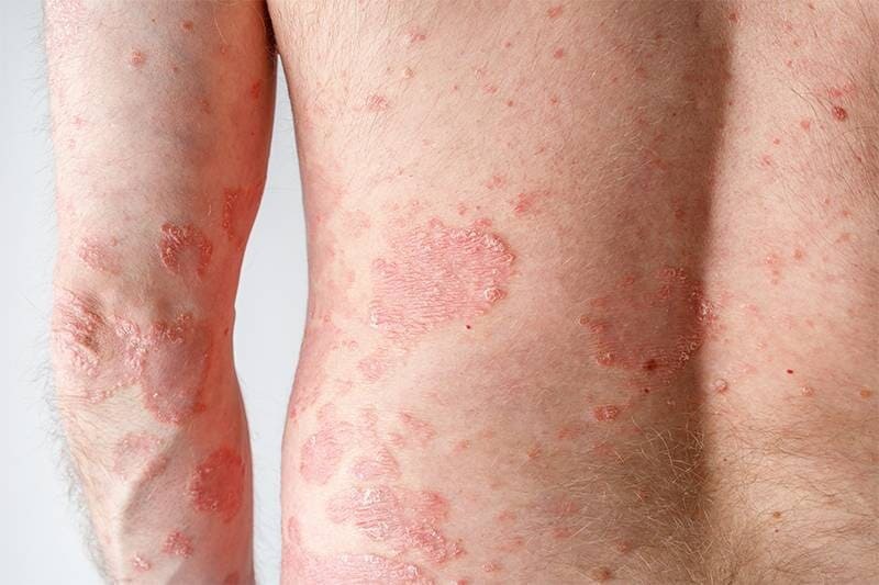 Biểu hiện bệnh vảy nến phấn hồng