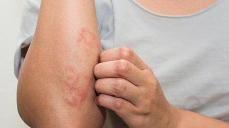 Giai đoạn vảy nến phấn hồng phát ban lan rộng